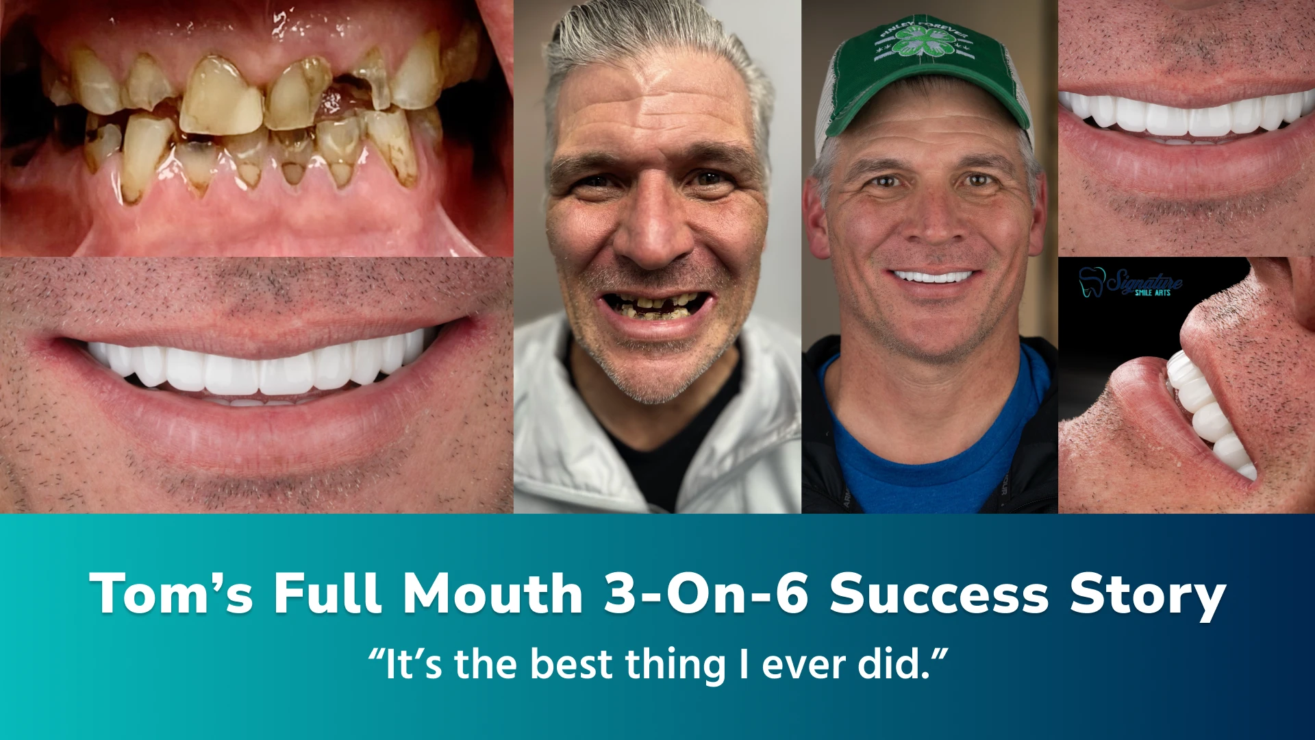 Tom's Full Mouth 3-On-6 Success Story